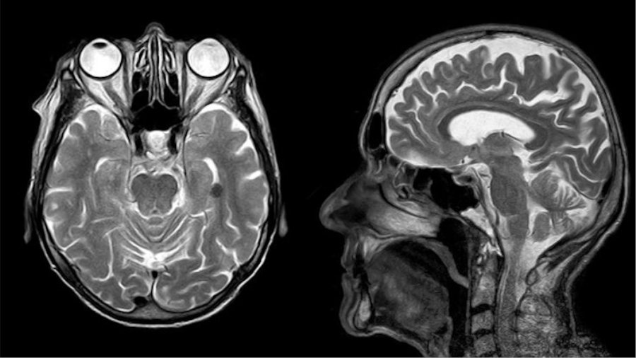 Araştırma: Korona virüsü kalıcı beyin hasarına neden oluyor